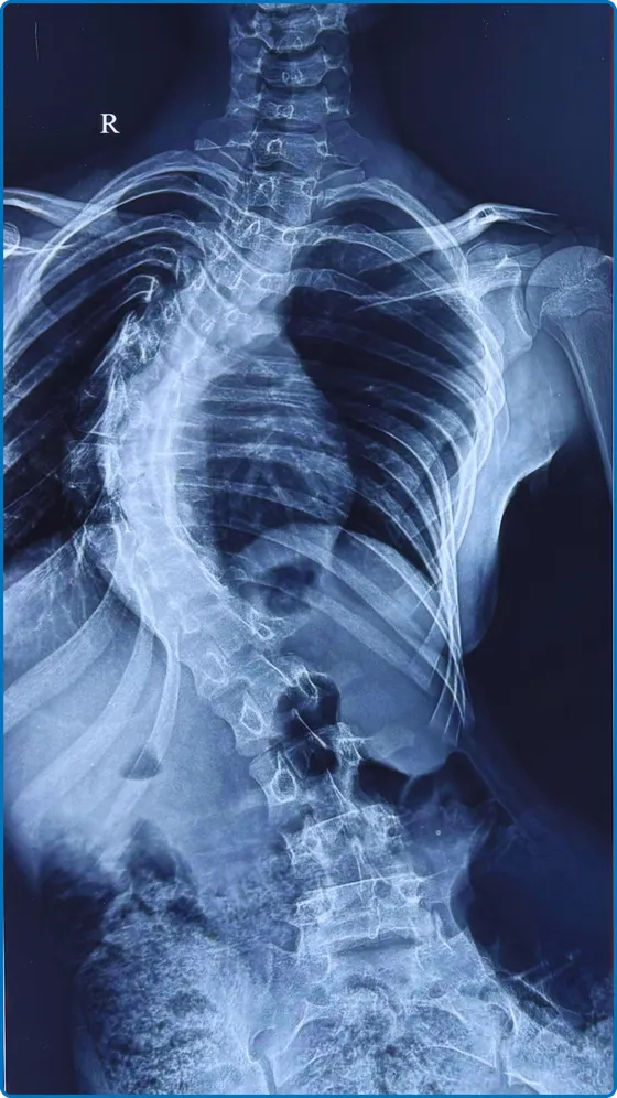 सर्जरी से पहले स्कोलियोसिस का X-ray
